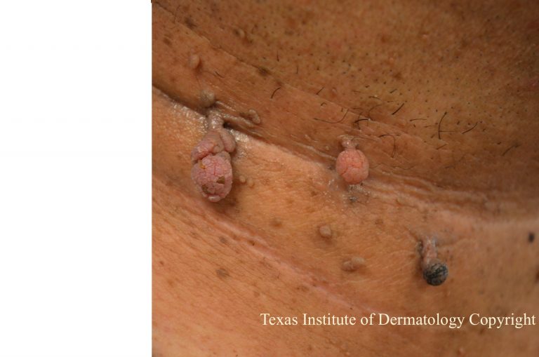 SKIN-TAG-TEXAS-INST-DERM-1